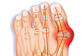 Bunions - What are they? How Do I fix them?