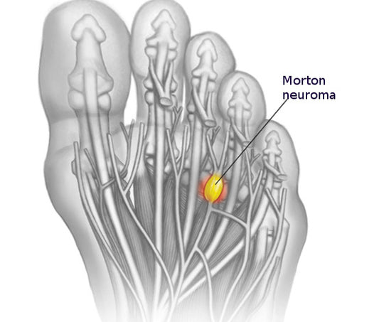 What is a Morton Neuroma and how can we fix it?